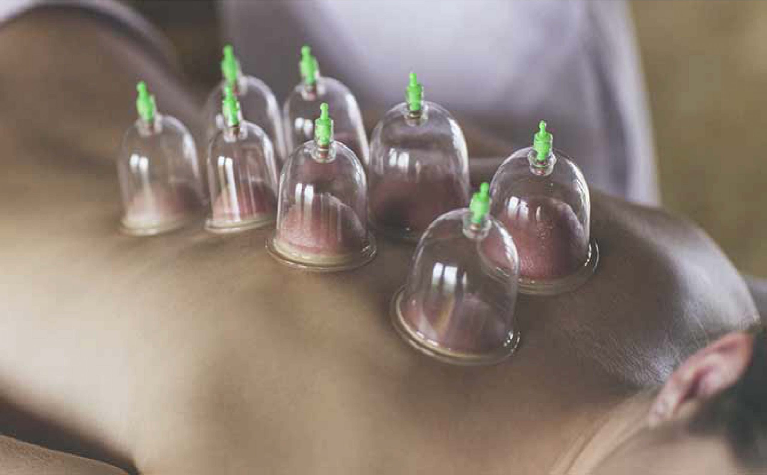 Cupping Therapy